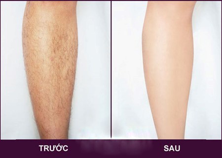 hinh-anh-truoc-sau-tri-lieu-frey